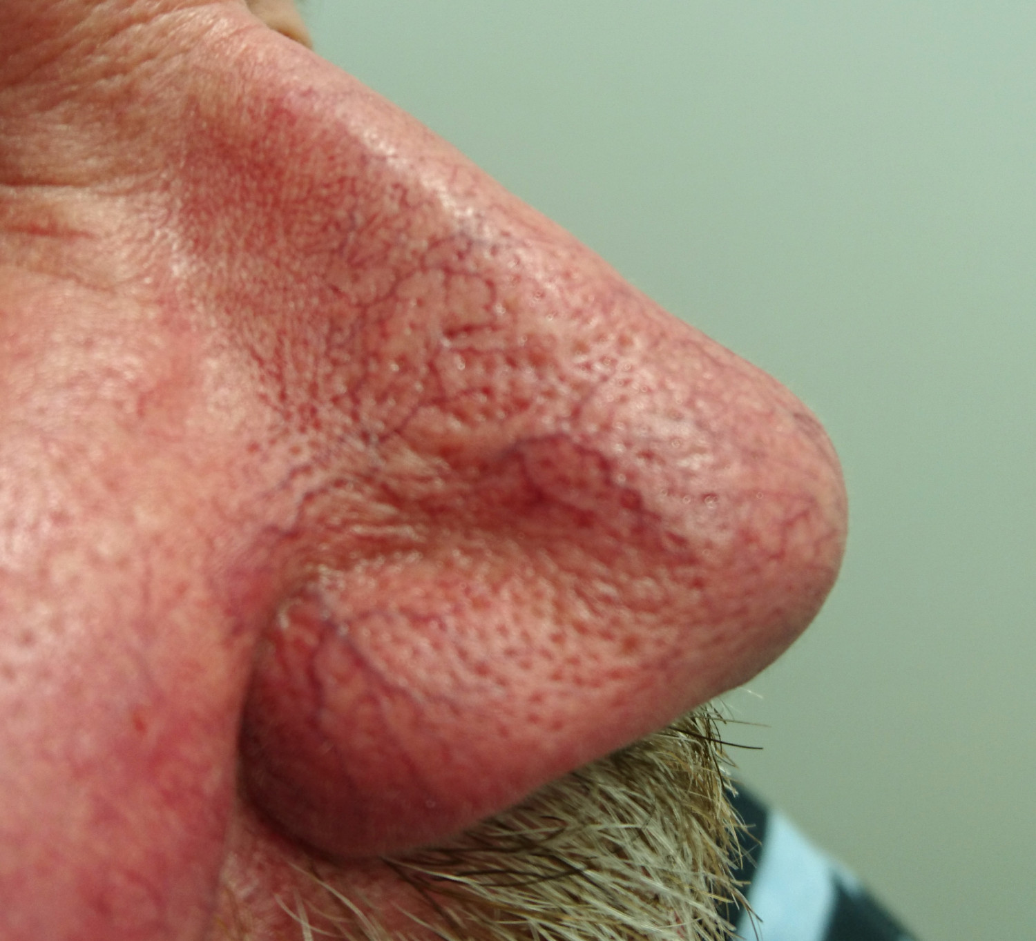 Figur 3 Fymat&oslash;s rosacea