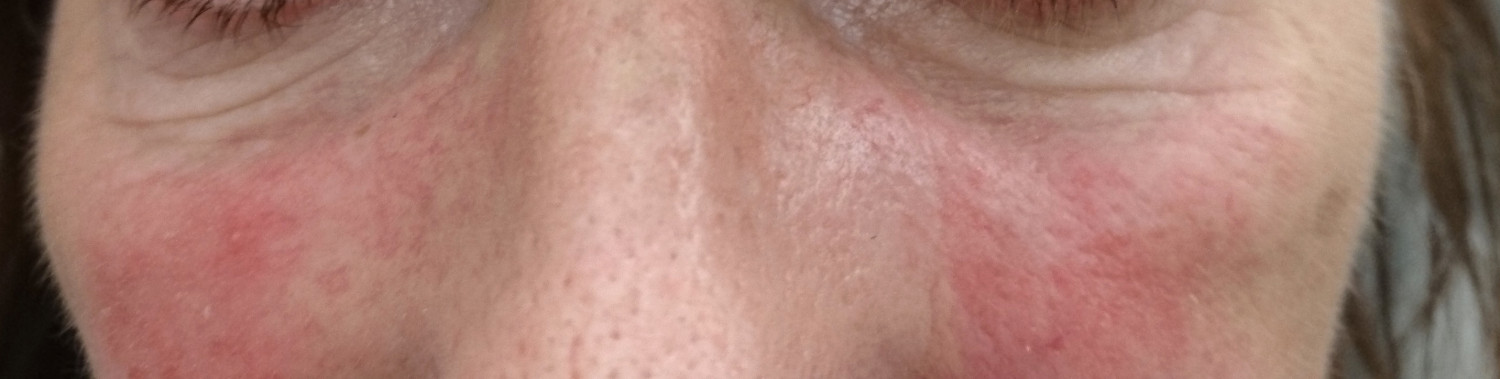 Figur 4 Okul&aelig;r rosacea
