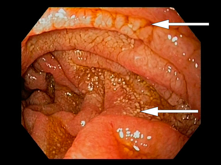 Figur 2 Gastroskopi. Flekkvis lymfangiektasi og erosjoner/furer i duodenum