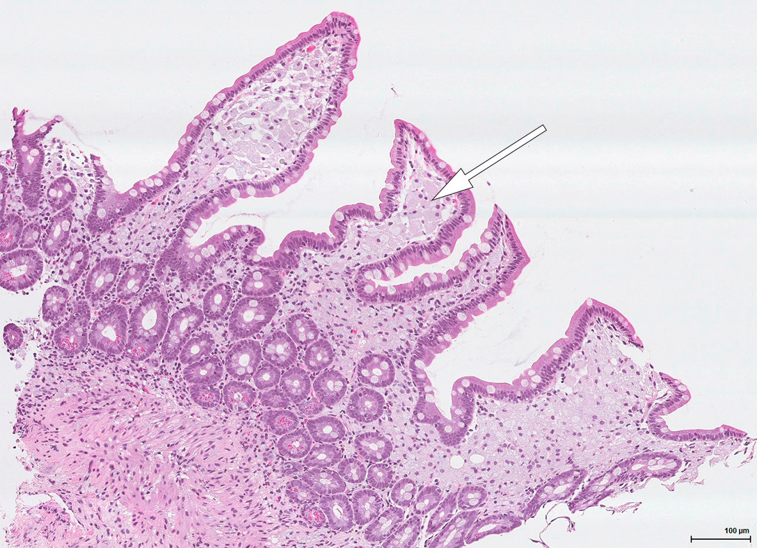 Figur 4 Hematoksylin-eosin-farget tynntarmsbiopsi (forst&oslash;rret 10 ganger) med bredde&oslash;kte, avflatede totter med rikelig med&hellip;