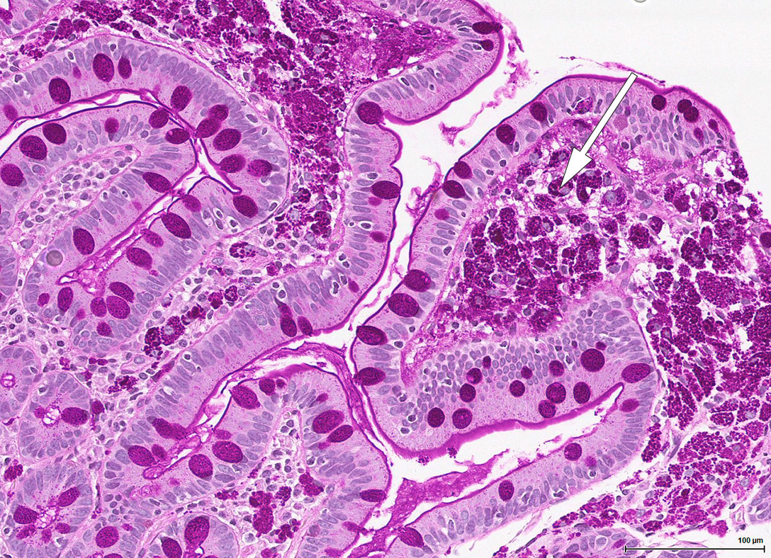 Figur 5 Periodisk syre-Schiff (PAS)-diastase (forst&oslash;rret 20 ganger). Ansamlinger av makrofager med PAS-diastase-positive&hellip;
