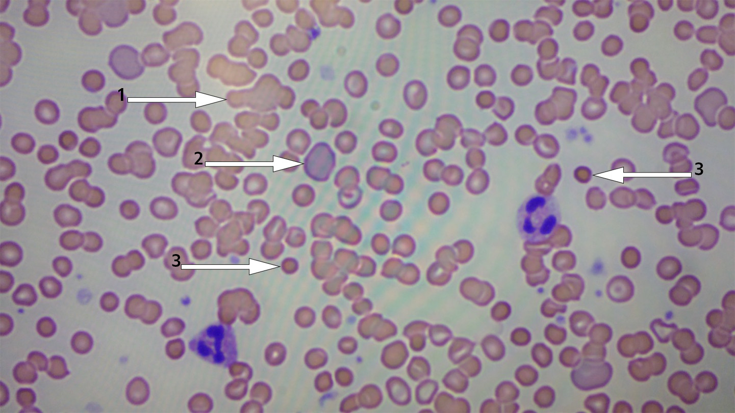Figur 1 Utstryk av perifert blod som viser agglutinering (merket 1), anisocytose (merket 2), polykromasi (merket 2) og&hellip;