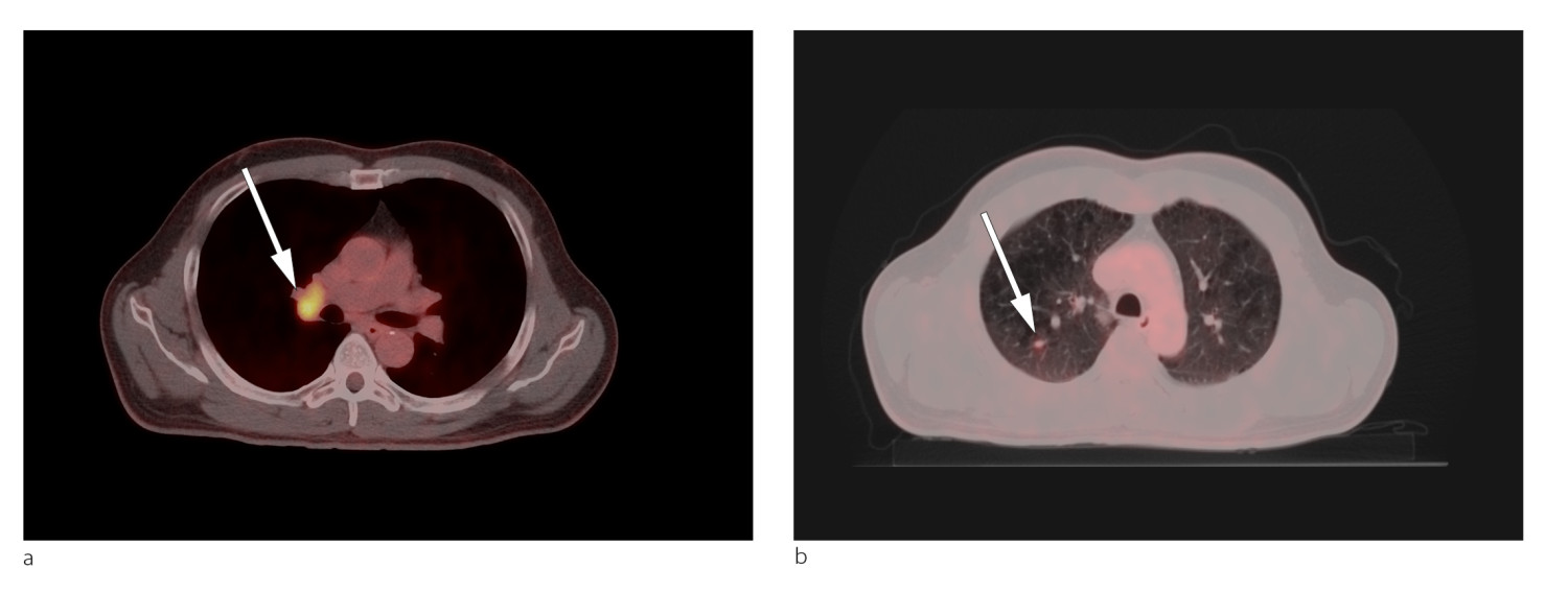 Figur 1 Pasienten ble unders&oslash;kt med 18F-fluoro-2-deoksyglukose-positronemisjonstomografi (FDG-PET). I samme seanse utf&oslash;res&hellip;