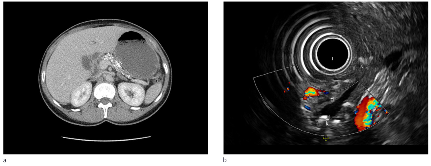 Figur 2 a) CT pancreas viser betydelige kalknedslag (merket k) i pancreas (fra Radiologisk avdeling, Haukeland&hellip;