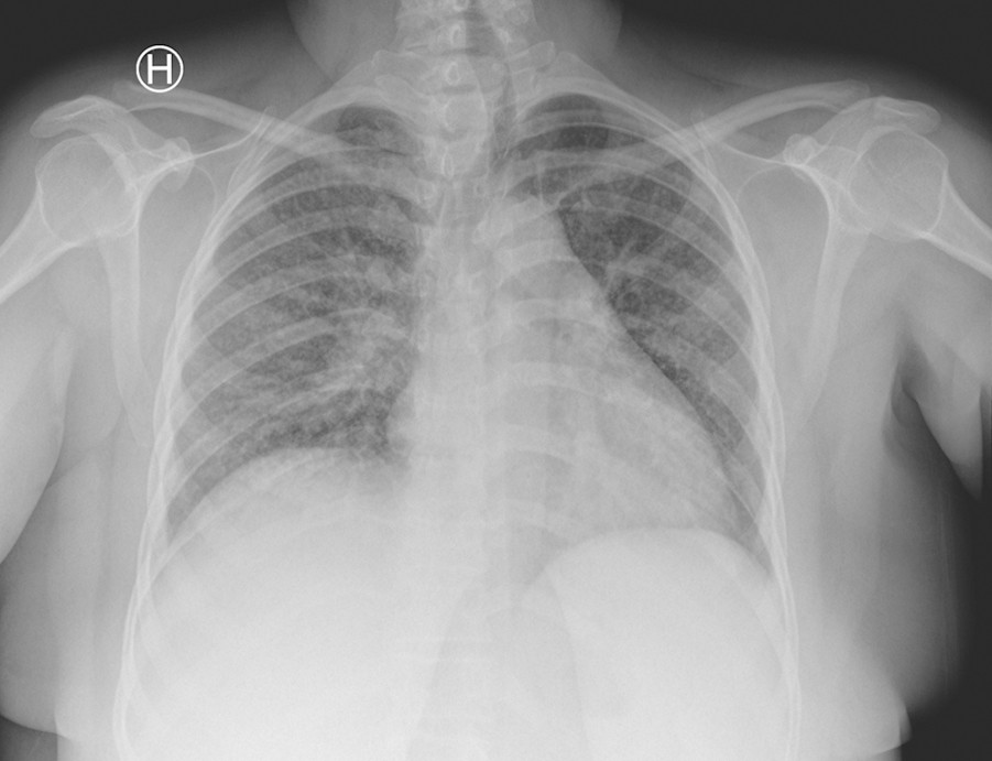 Figur 1 R&oslash;ntgen thorax (dag 1) viser sm&aring; nodul&aelig;re infiltrater bilateralt