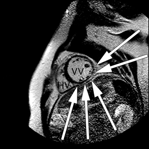 Figur 2 Magnetresonansbilde av hjertet med gadoliniumkontrast av pasient med myokardiell sarkoidose. Bildet er tatt i&hellip;