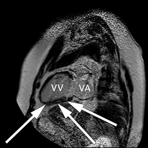 Figur 3 Magnetresonansbilde av hjertet med gadoliniumkontrast av pasient med myokardiell sarkoidose. Bildet er tatt i&hellip;