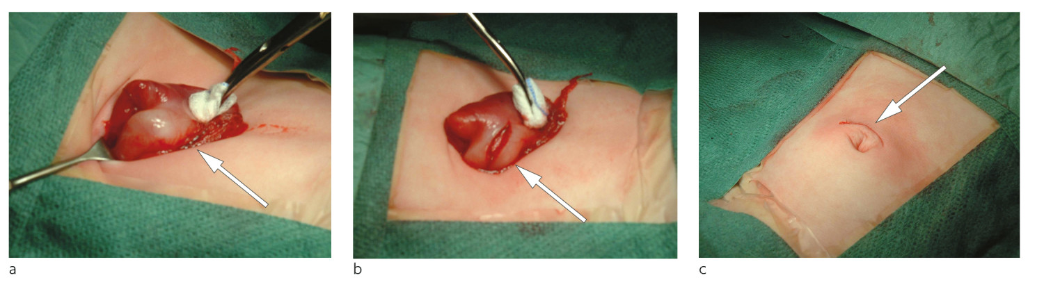 Figur 2 a) Pylorus hentes ut p&aring; buken (pil) via navlesnittet. b) Pylorus spaltes stumpt ned til mucosa (pil). c) Bueformet&hellip;