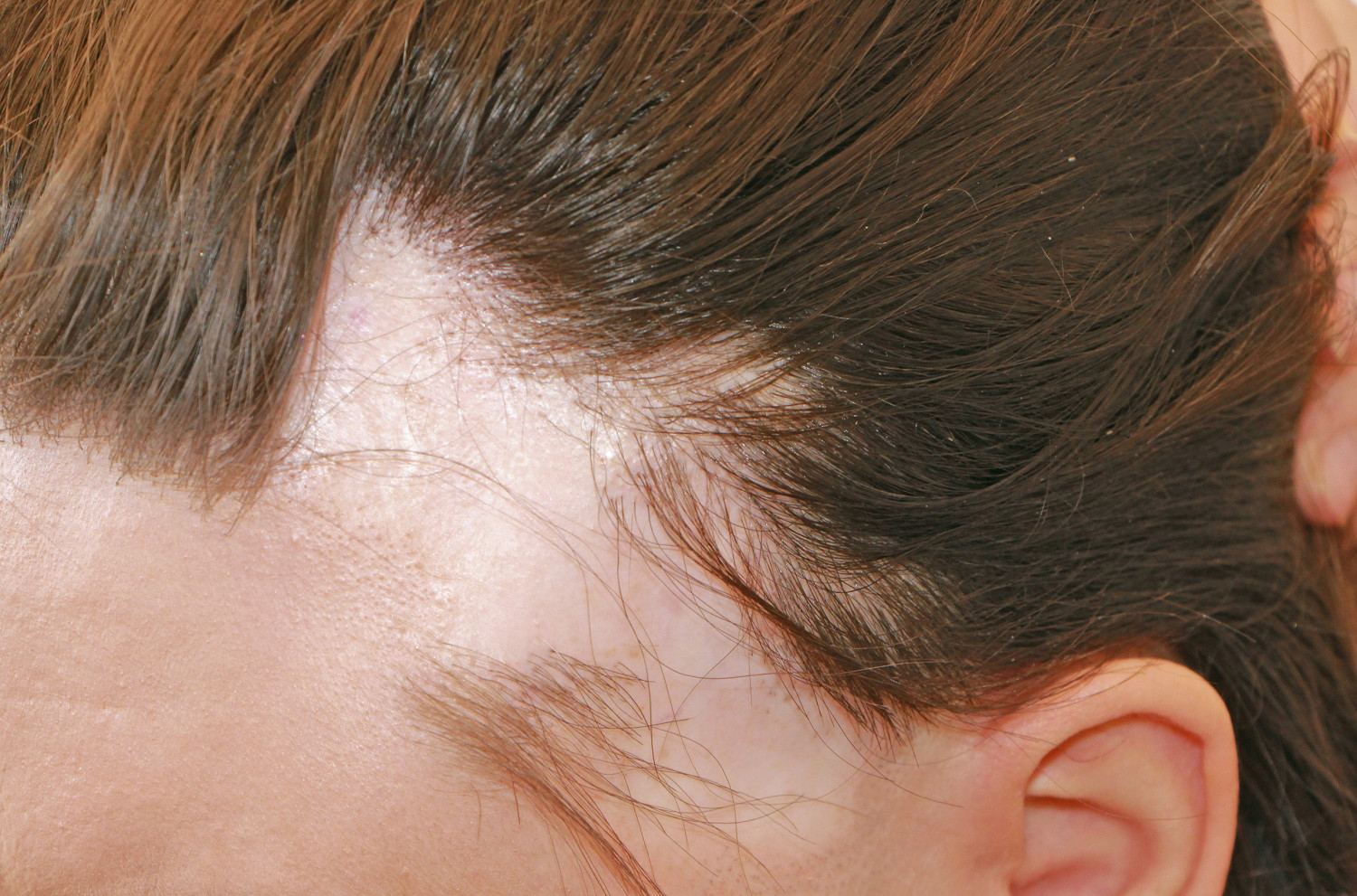 H&aring;rtap som f&oslash;lge av trikotillomani er som oftest reversibelt. Denne kvinnen hadde nappet i over ti &aring;r og fikk bare delvis&hellip;