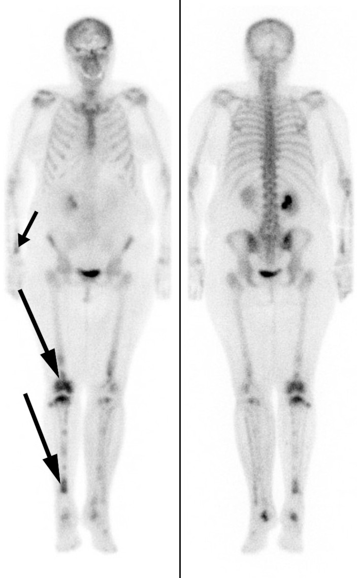 Figur 3 Skjelettscintigrafi med technetium-99 m som viser &oslash;kt radionuklidopptak i begge underekstremiteter, s&aelig;rlig i&hellip;