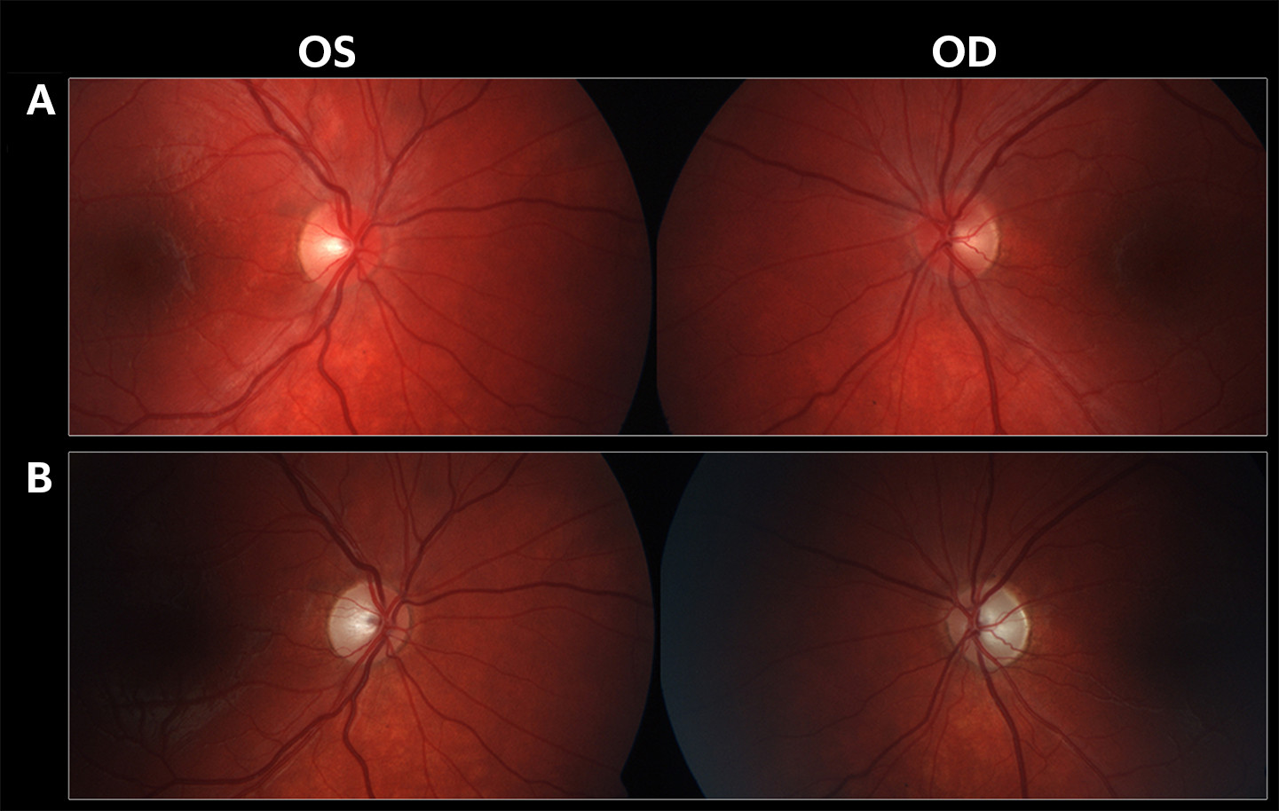 Figur 2 Fundusfoto av h&oslash;yre (OD) og venstre (OS) papill i akutt (A) og kronisk fase (B). I akutt fase er papillene lett&hellip;