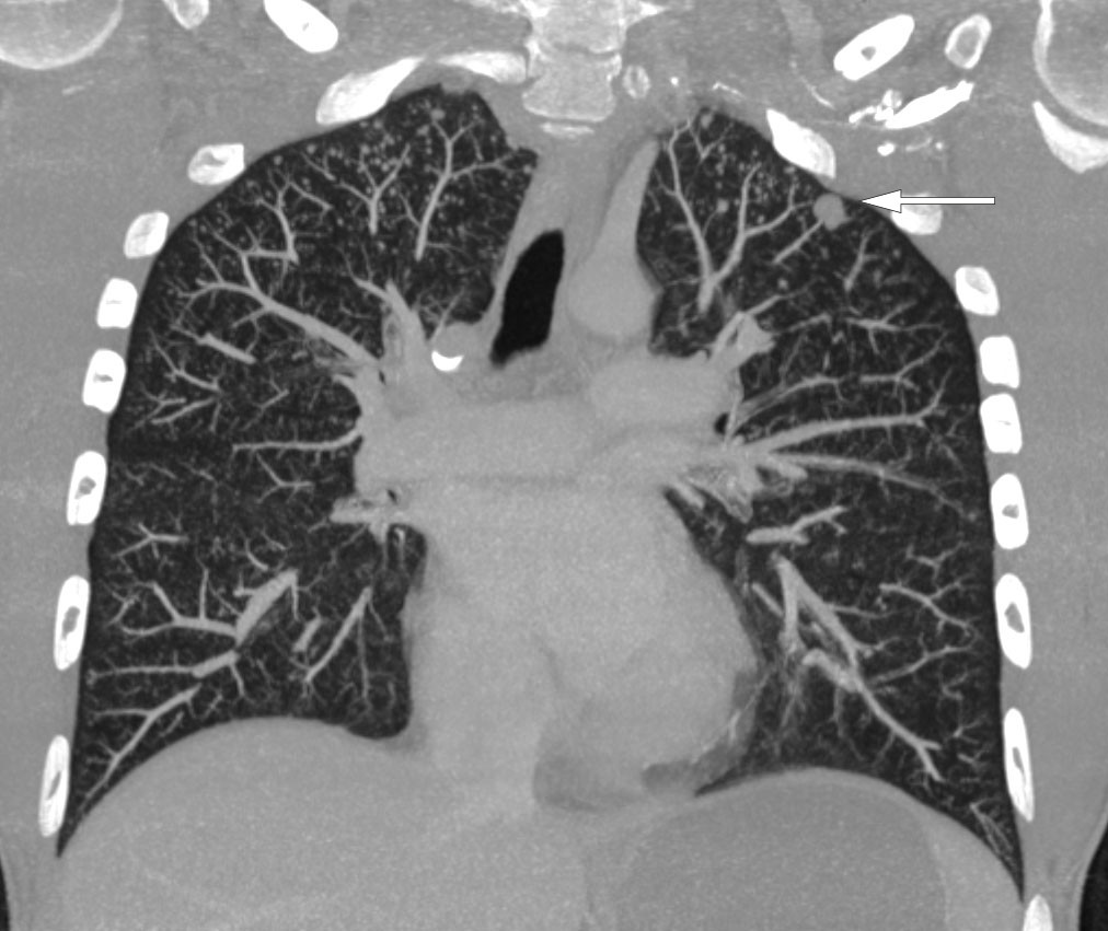 Figur 3 CT thorax tatt etter injeksjon av intaven&oslash;st kontrastmiddel. Bildet viser multiple mikronoduli i begge lungetopper&hellip;