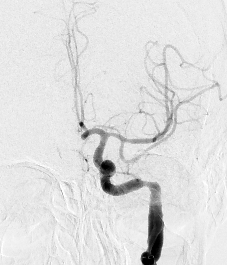 Figur 3 Angiografisk kontroll etter mekanisk trombektomi viste normal fylling av arterien