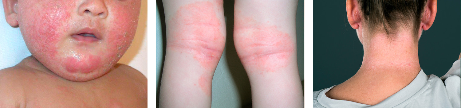 Figur 1 Atopisk eksem i forskjellige aldersgrupper. Hos spedbarn er utslettet vanligvis lokalisert til hodet og&hellip;