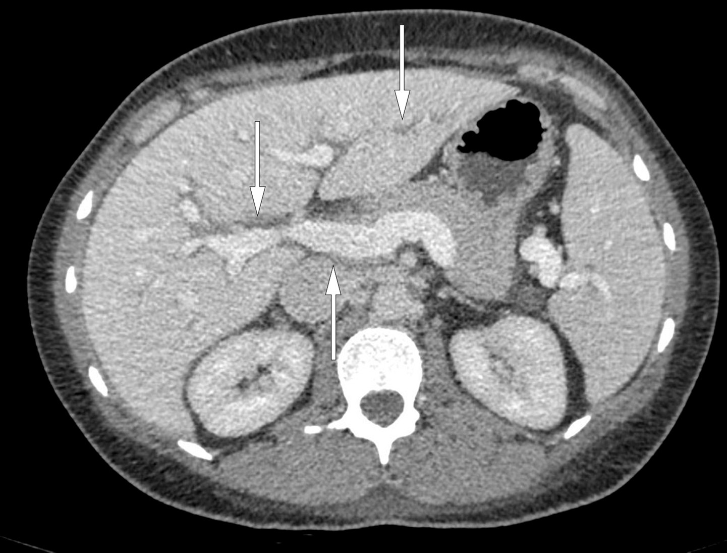 Figur 1 CT abdomen viser periportalt &oslash;dem (piler).