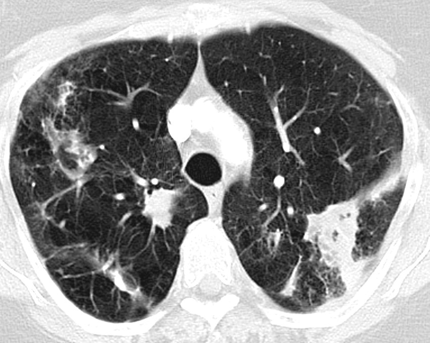 Figur 1 CT thorax av en pasient med alvorlig kols med emfysem. Det ses kavern&oslash;se og fibrotiske forandringer samt infiltrater&hellip;