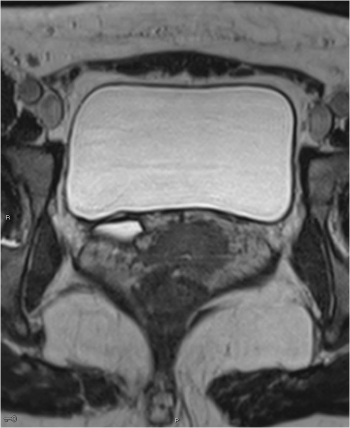 Figur 2 MR. Transversalt 3D-snitt med T2-vekting med h&oslash;y oppl&oslash;sning. Ektopisk dilatert ureter p&aring; h&oslash;yre side.