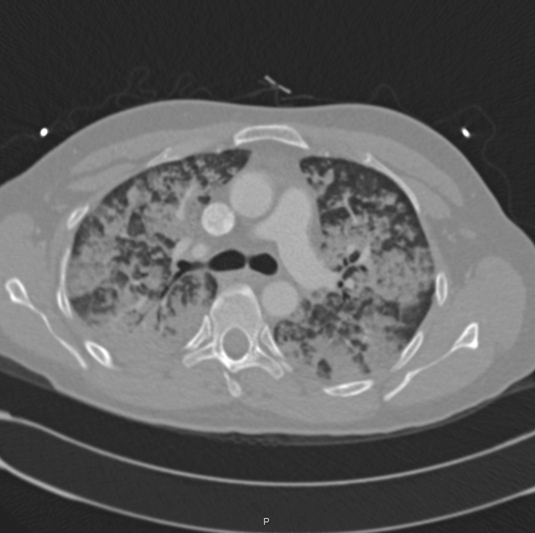 Figur 2 CT thorax viser uttalte mattglassfortetninger i alle lungelapper som delvis konfluerer som ved akutt lunge&oslash;dem.