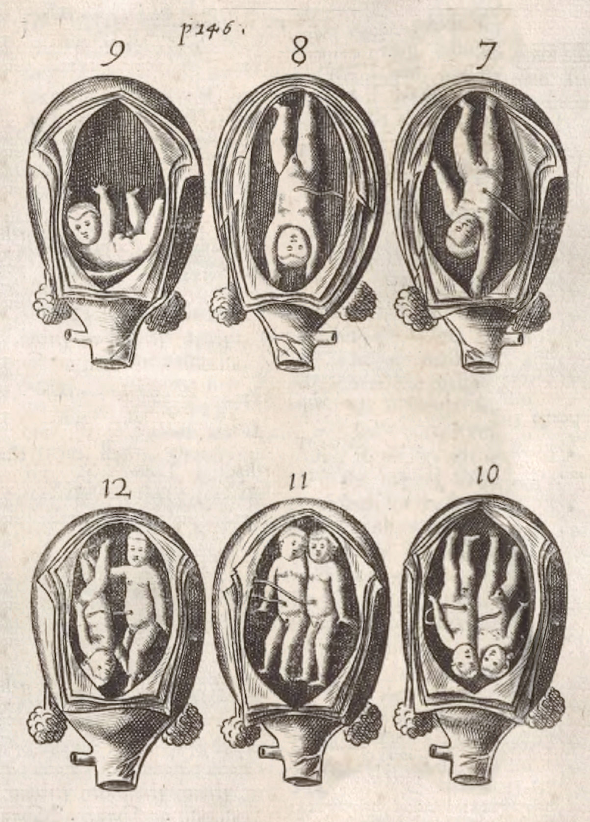 Figure 2 Twins in utero in Thomas Chamberlayne's book for midwives, The Compleat Midwife's Practice Enlarged from 1656&hellip;