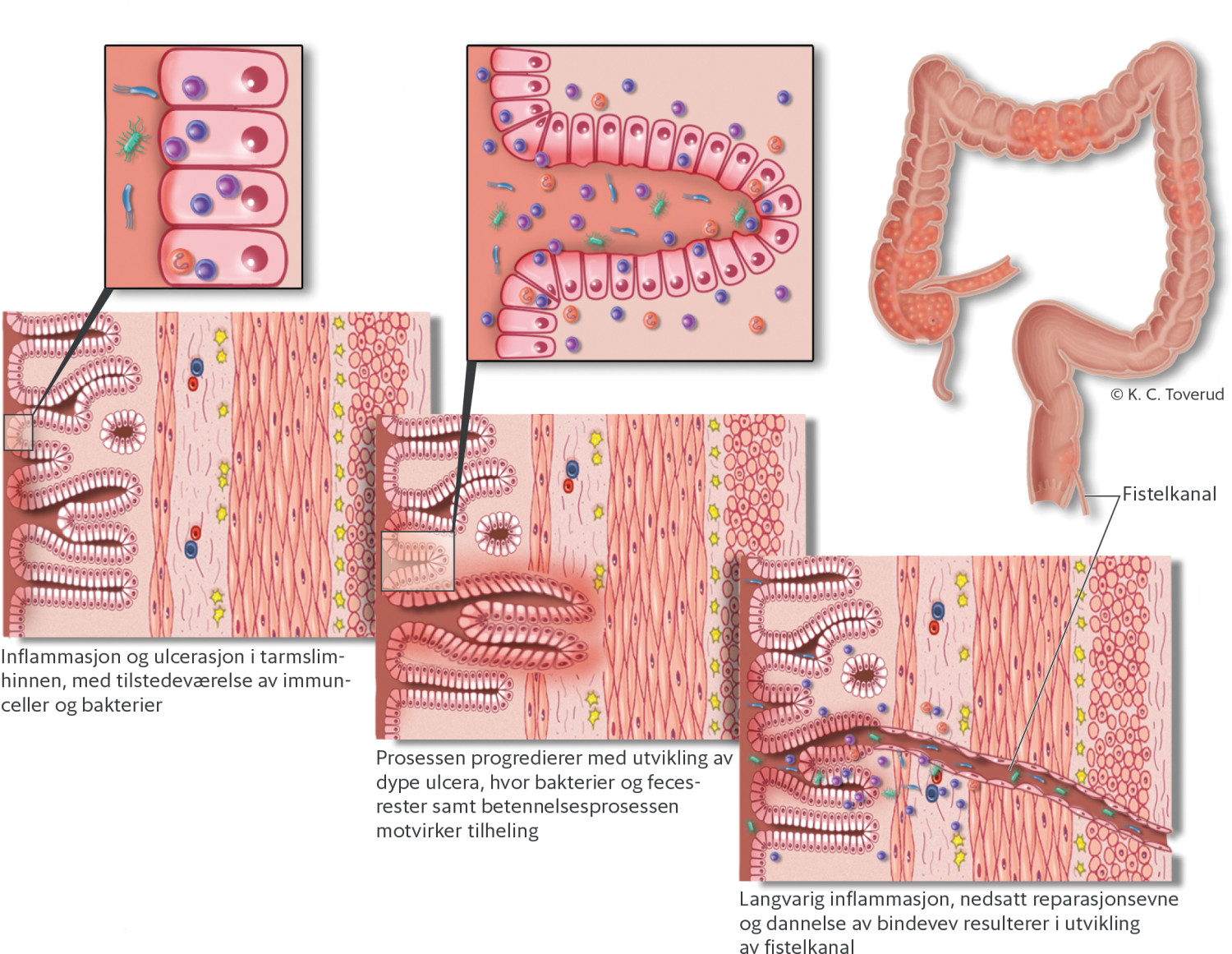 Figur 1 Antatt patogenese ved fistulerende Crohns sykdom.