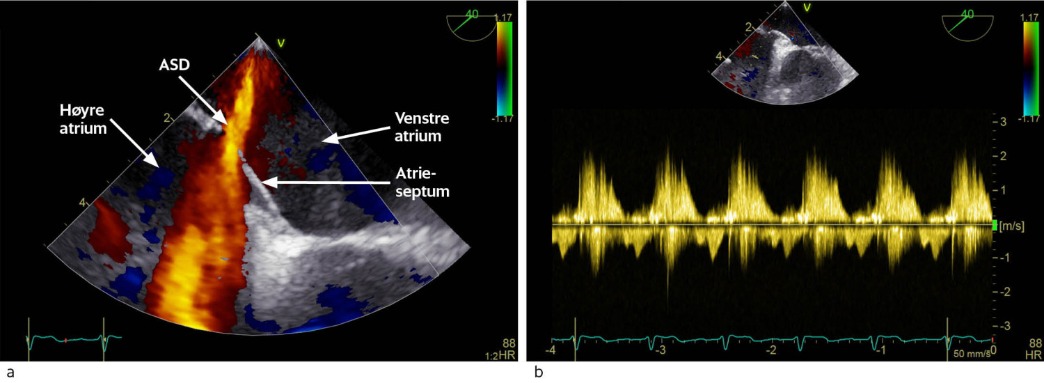Figur 2 a) Trans&oslash;sofageal ekkokardiografi med fargedoppler viser trikuspidalinsuffisiensen som treffer rett p&aring;&hellip;