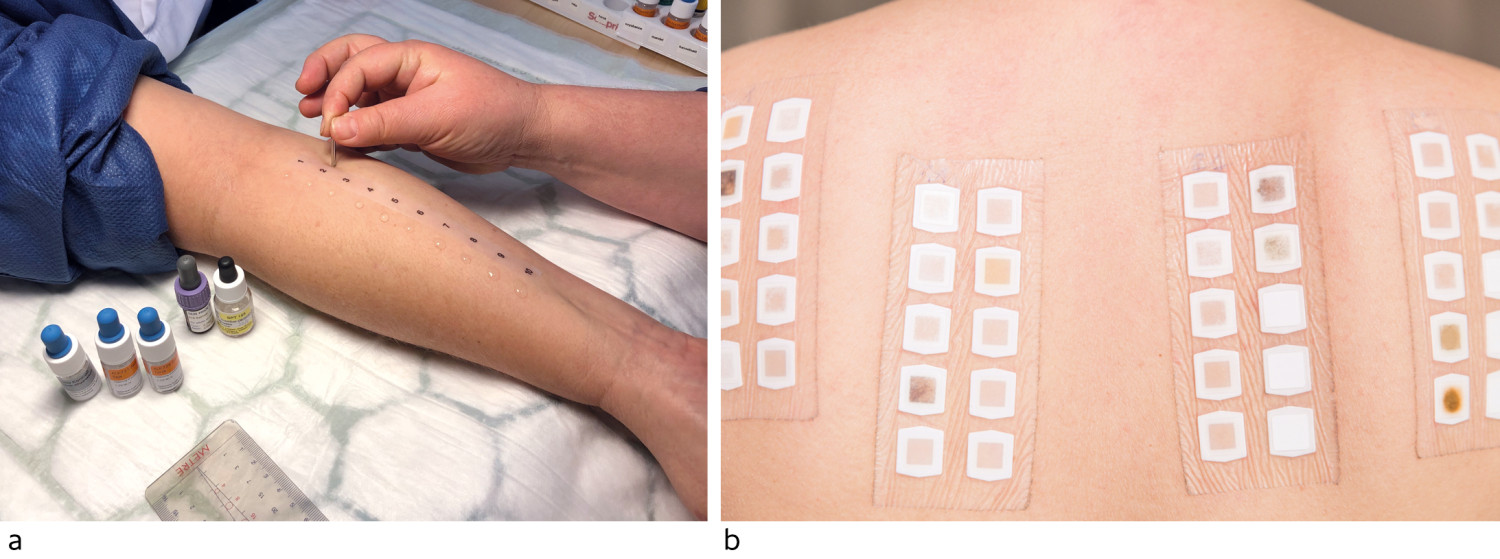 Figur 3 a) Prikktesting. Foto: Regionalt senter for astma, allergi og overf&oslash;lsomhet, Oslo universitetssykehus. b)&hellip;