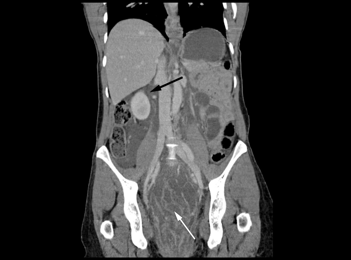 Figur 1 Frontalsnitt (koronalsnitt) av CT abdomen/bekken, med uttalt fortykket og &oslash;demat&oslash;s rektumvegg (hvit pil), og&hellip;