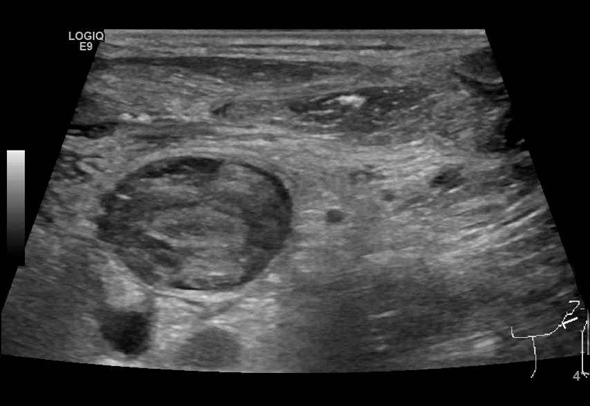 Figur 2 Ultralydfremstilling av trombemasse i venstre vena jugularis interna, tverrsnitt.