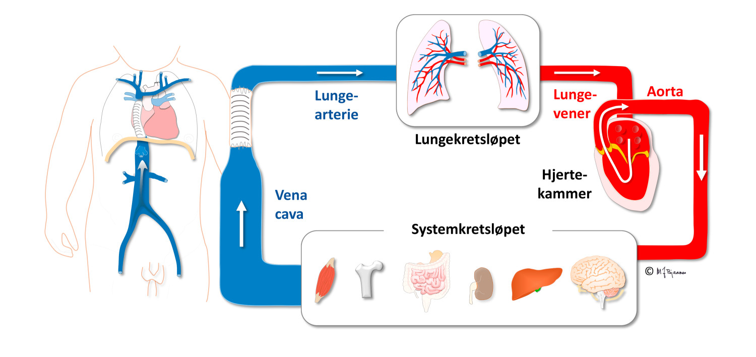 Figur 2 Fontan-sirkulasjon der det funksjonelle hjertekammeret pumper arterielt blod til systemkretsl&oslash;pet. Blodet fra&hellip;