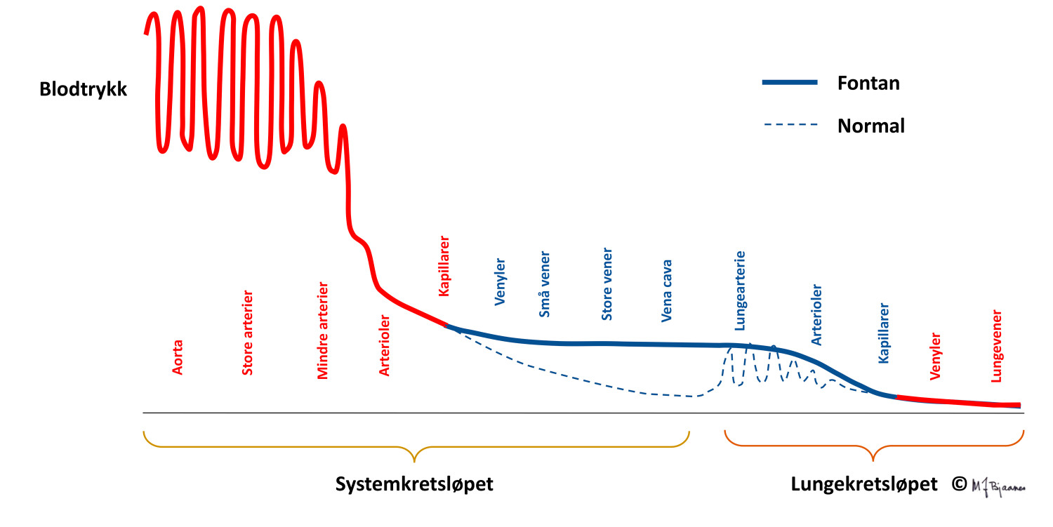Figur 3 Trykkforhold i Fontan-sirkulasjon sammenlignet med normal sirkulasjon. Illustrasjonen er utarbeidet av Michael&hellip;