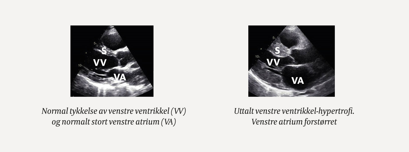 Figur 2 Venstre panel viser todimensjonal ekkokardiografi av et normalt hjerte. H&oslash;yre panel viser hjerte med hypertrofisk&hellip;