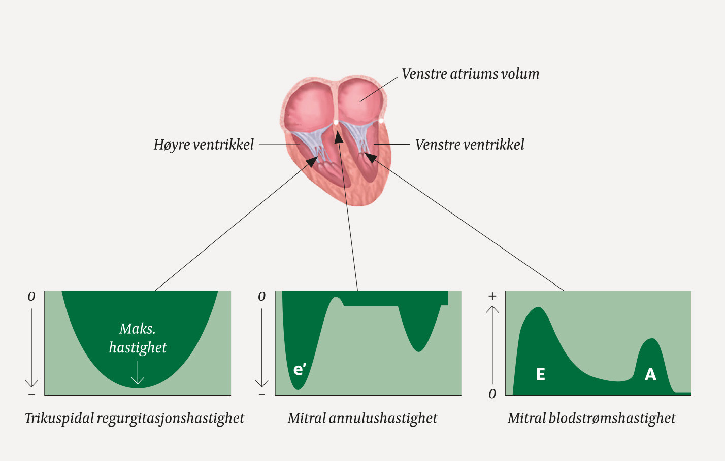 Figur 4 Ekkokardiografi til estimering av venstre ventrikkels fylningstrykk. Trikuspidal regurgitasjonshastighet: De fleste&hellip;