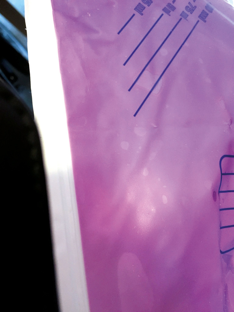 Figur 1 Utsnitt av pasientens kateterpose med lillafarget urin.