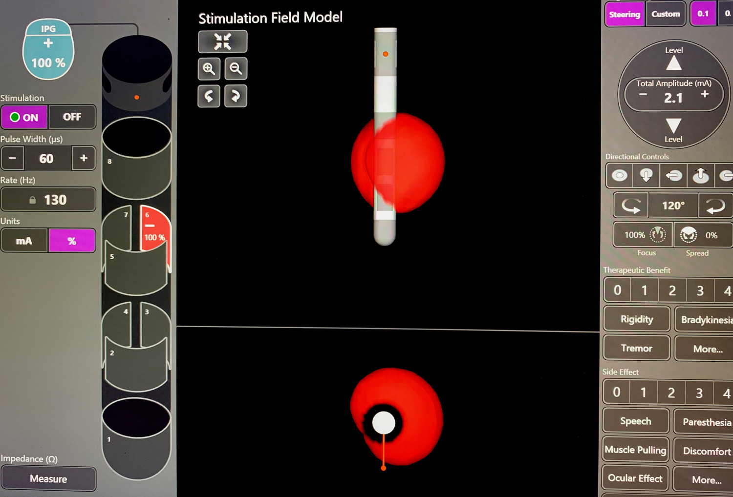 Figur 1 Foto fra programmeringsenheten som viser en segmental elektrode for dyp hjernestimulering, der stimulering skjer&hellip;