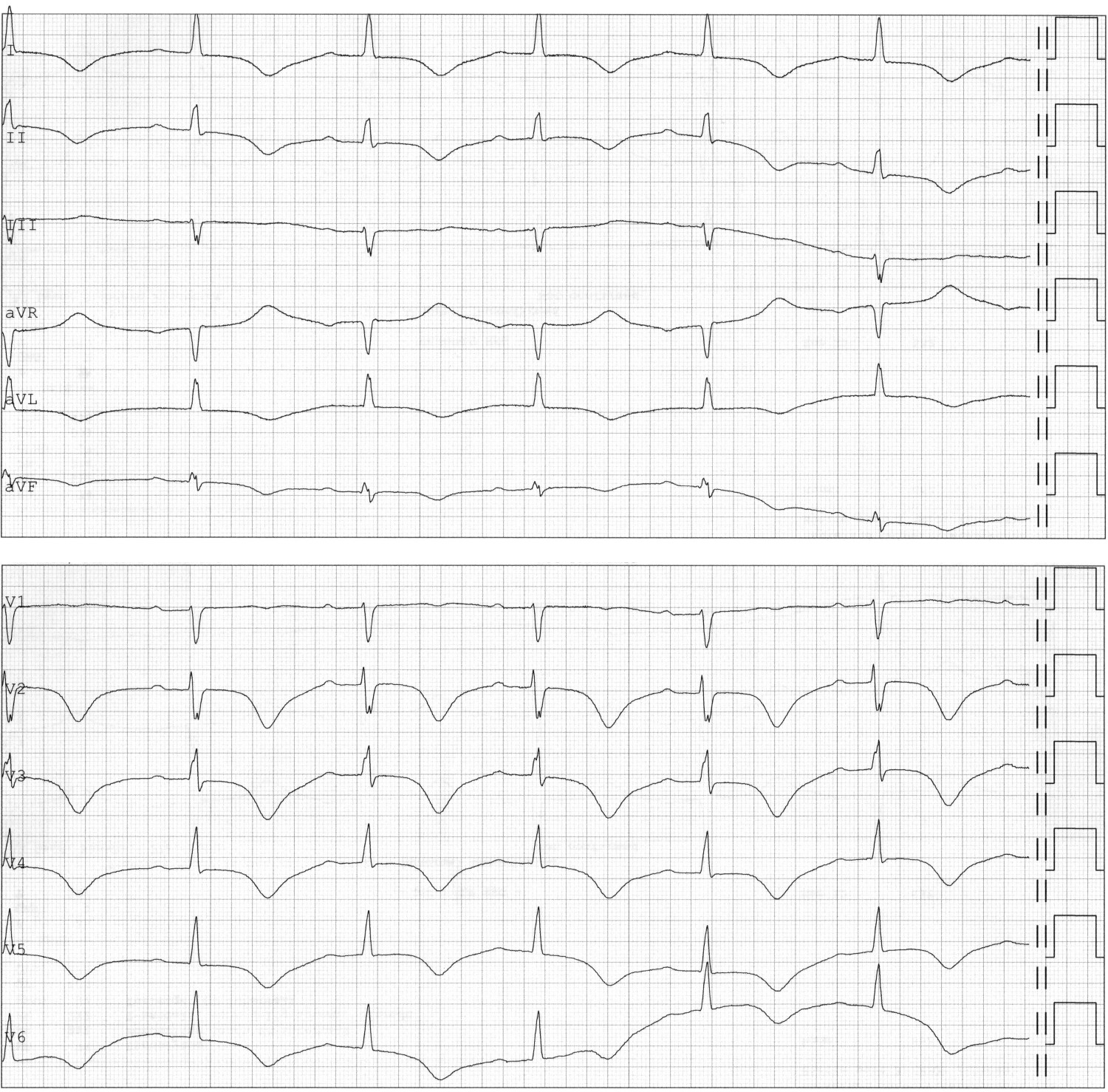 Figur 3 EKG fra dag 11 viser sinusrytme, men nytilkommet T-inversjon i standardavledningene I, II, avL og aVF og i&hellip;