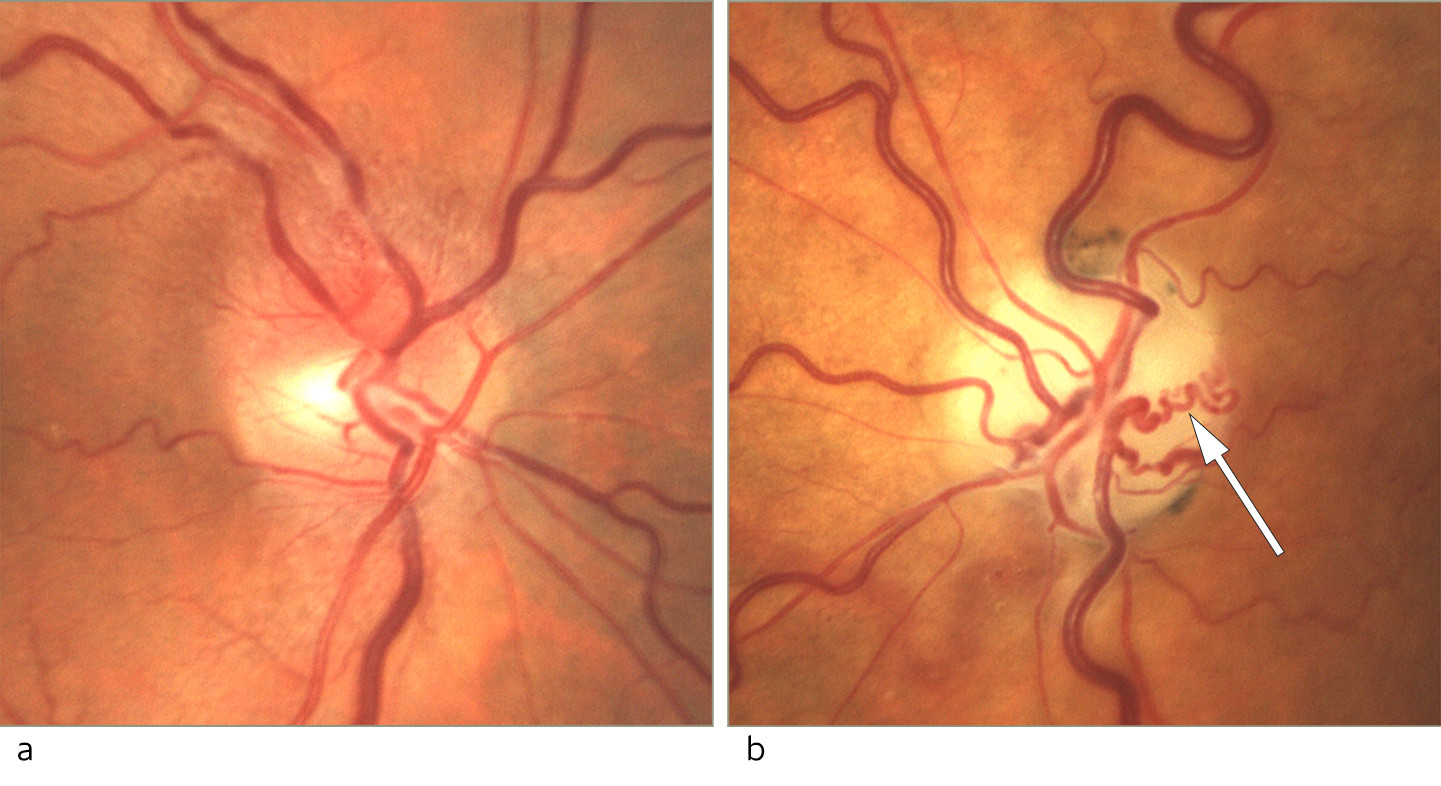 Figur 1 a) Fundusfoto av h&oslash;yre &oslash;ye viser et papill&oslash;dem, mest uttalt oppad. b) Fundusfoto av venstre &oslash;ye viser en blek og&hellip;