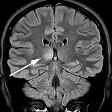 Figur 2 Lesjon i h&oslash;yre thalamus p&aring; koronal MR-unders&oslash;kelse med FLAIR (fluid-attenuated inversion recovery).