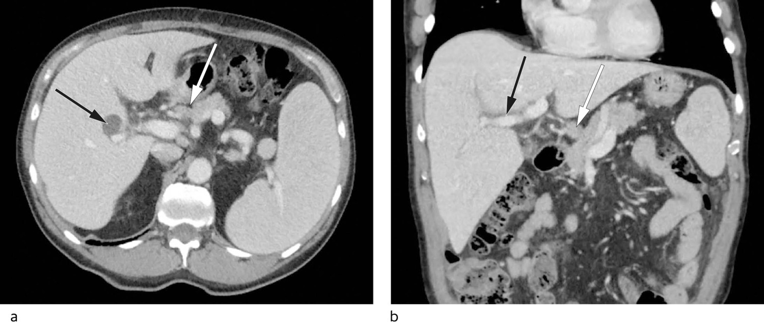 Figur 1 a) CT-bilde i aksialplan av &oslash;vre abdomen med forst&oslash;rret milt og bimilt, markerte lymfeglandler i leverhilus (hvit&hellip;