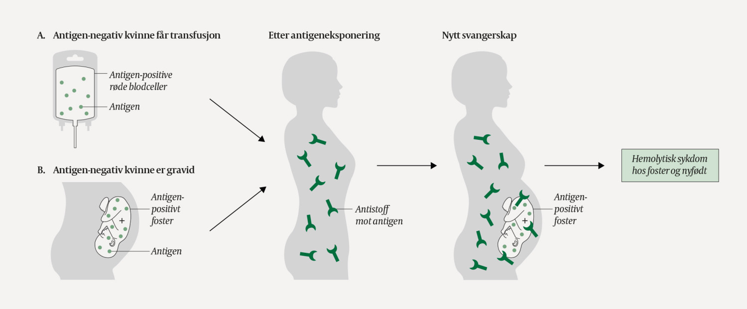 Figur 3 En kvinne som eksponeres for antigen(er) hun ikke har p&aring; egne erytrocytter, kan danne blodtypeantistoff rettet mot&hellip;