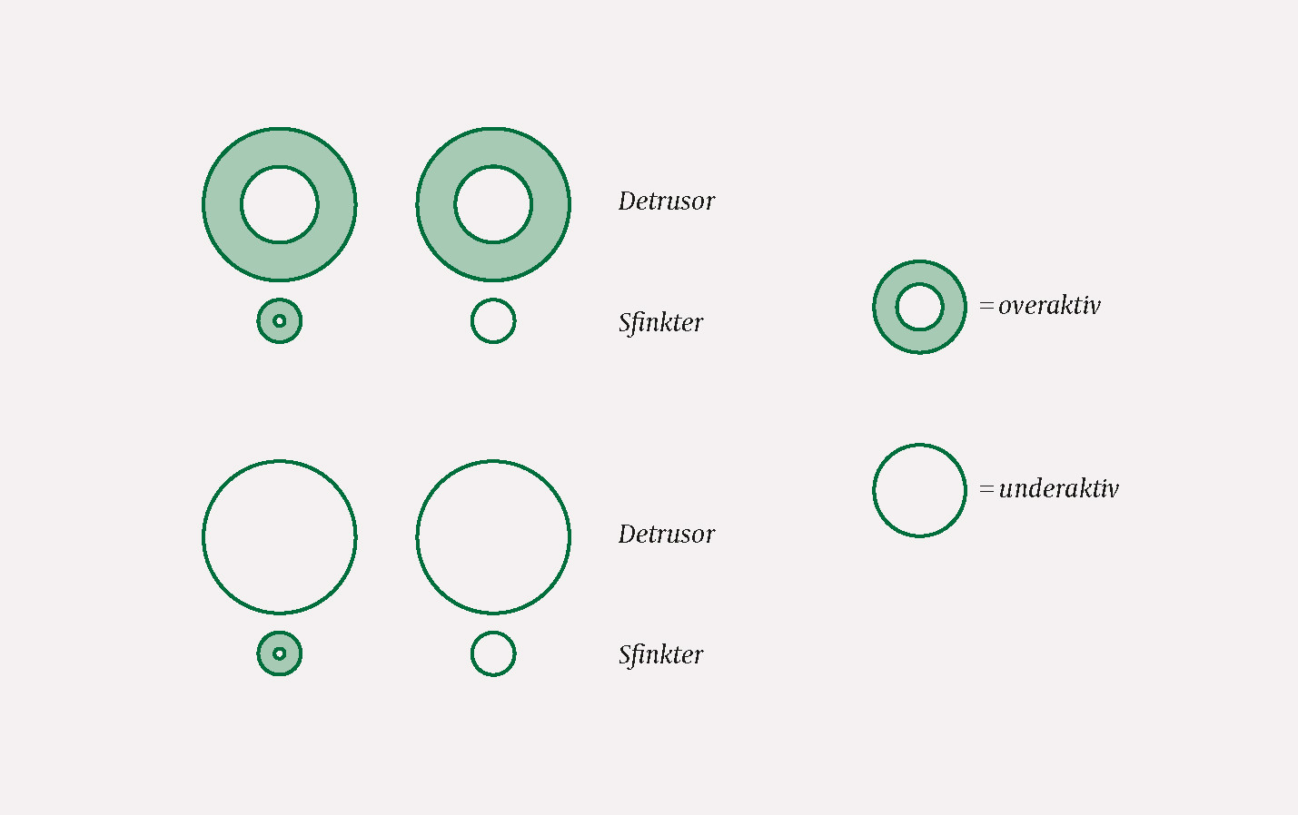 Figur 2 De fire hovedtypene av urodynamiske forstyrrelser ved nevrogen bl&aelig;reforstyrrelse: over- eller underaktiv&hellip;
