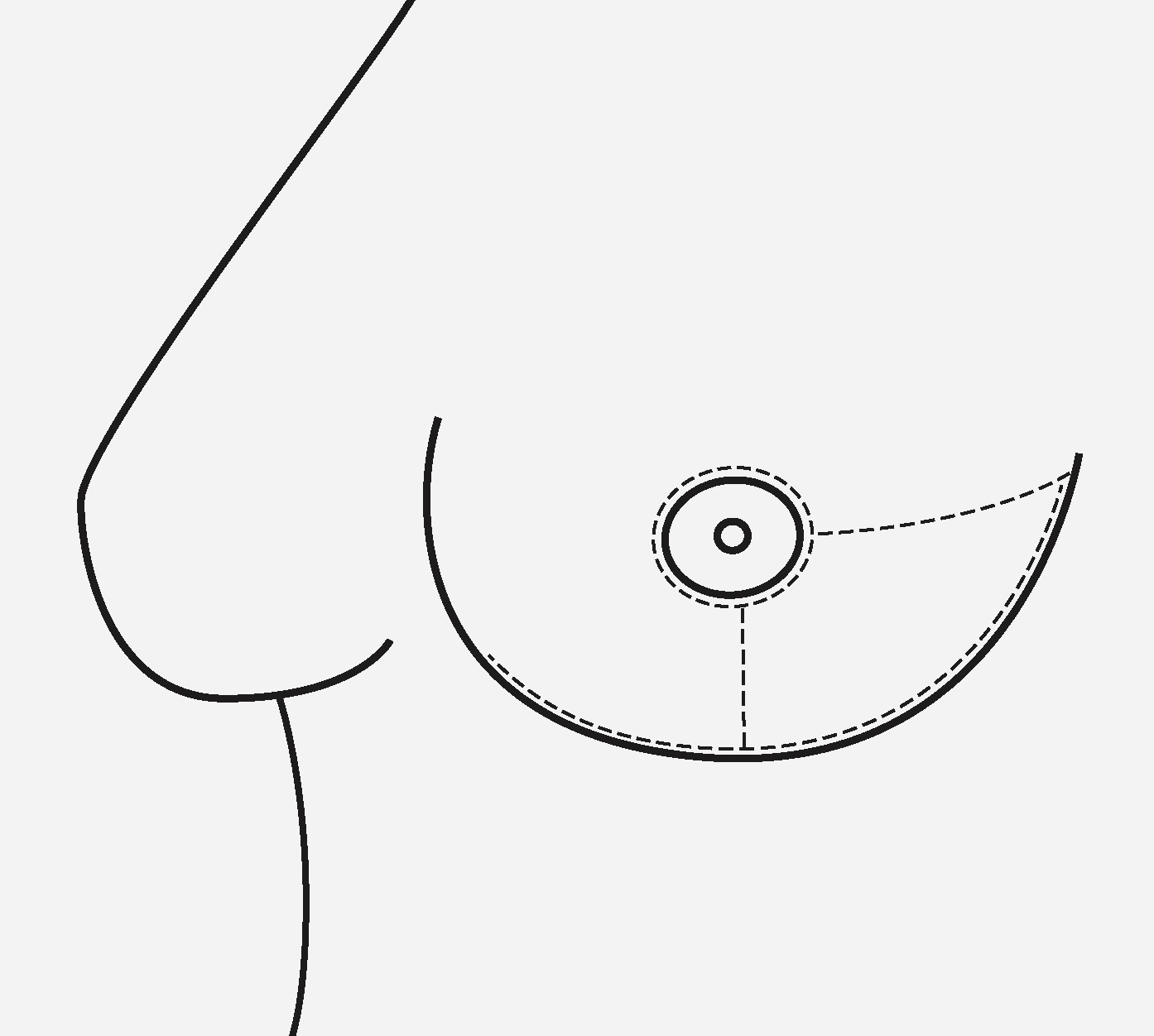 Figur 3 Incisjonslinjer som harmoniserer med onkoplastiske teknikker, og som vil kunne skjules godt i etterkant.