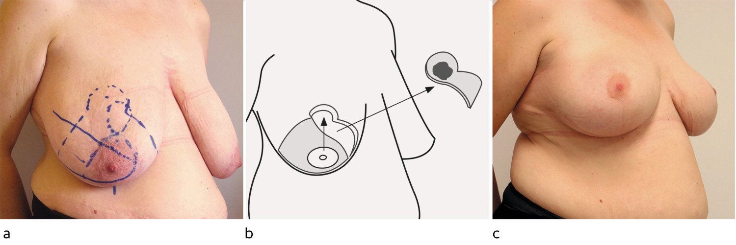 Figur 4 Onkoplastisk brystreduksjon med symmetrisering av motsatt side. a) F&oslash;r operasjon. Svulsten er markert med prikket&hellip;