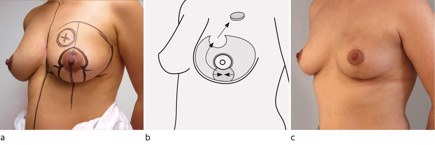 Figur 5 Onkoplastisk brystl&oslash;ft. Kun venstre bryst er operert. a) F&oslash;r operasjon. Svulsten ligger oppad medialt i brystet og&hellip;