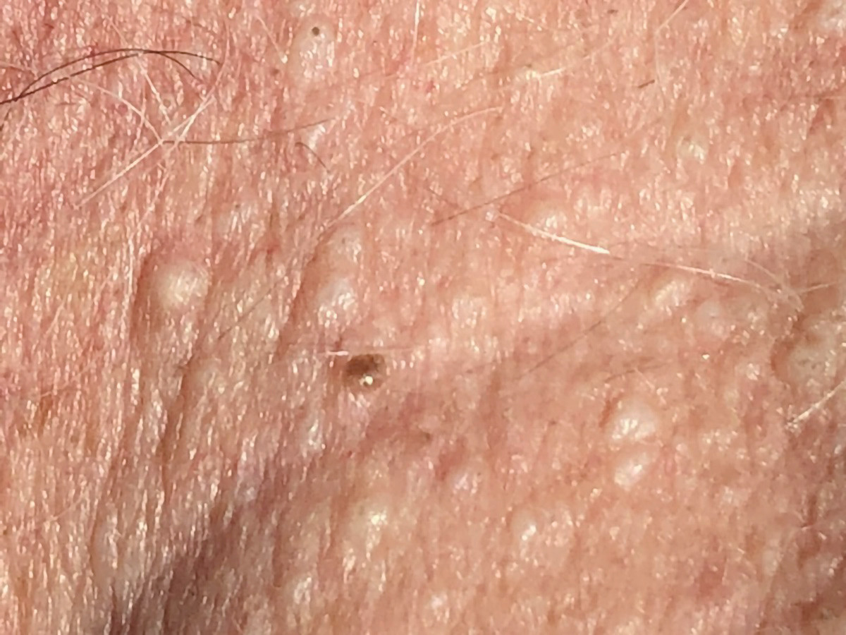 Figur 2 Fibrofollikulomer ved Birt-Hogg-Dub&eacute;-syndrom, n&aelig;rbilde av nakke.