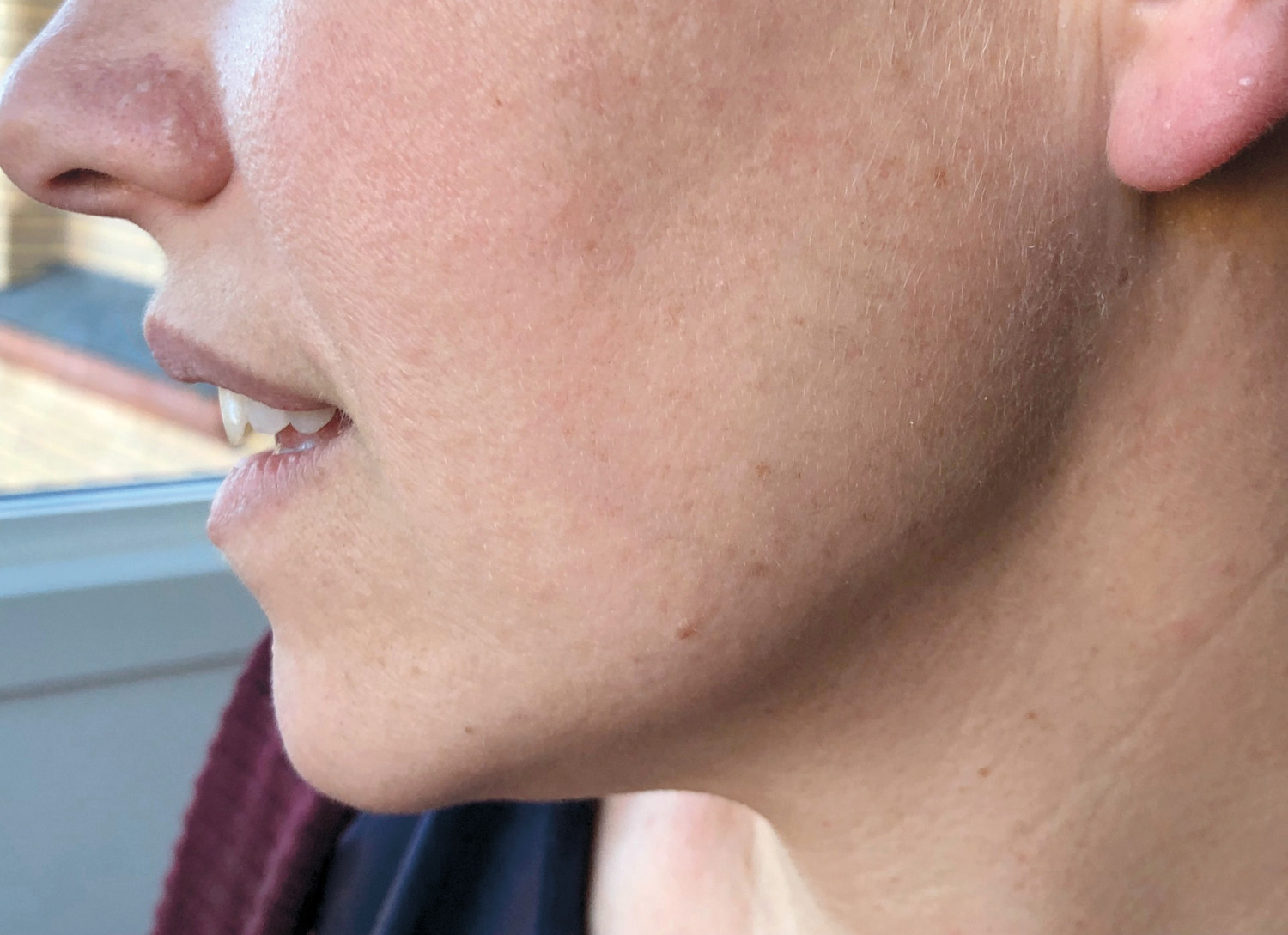 Figur 3 Diskrete fibrofollikulomer i ansikt.