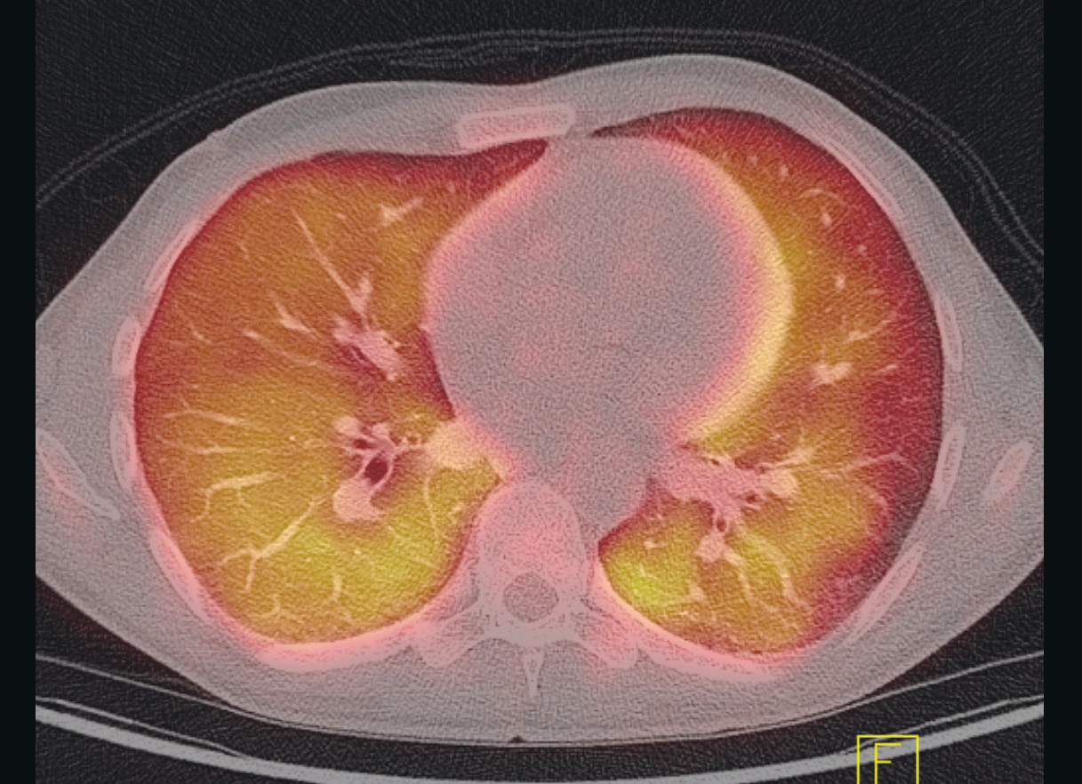 Figure 1 PET-CT showed strong, diffuse uptake of &sup1;⁸F-fluorodeoxyglucose in the lung parenchyma (yellow).