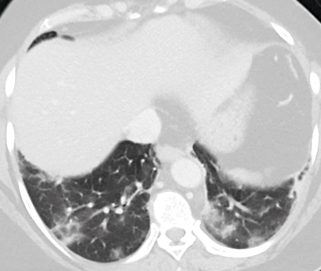 Figur 1 CT-bilde av basale lungesnitt som del av CT-unders&oslash;kelse av abdomen. Her vises perifere, flekkvise bilaterale&hellip;