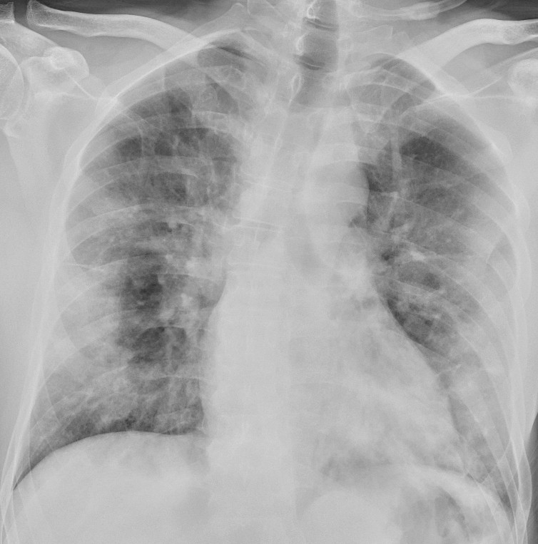 Figure 2 Patient with COVID-19 hospitalised after ten days of headache and dry cough, the last three days increasing&hellip;