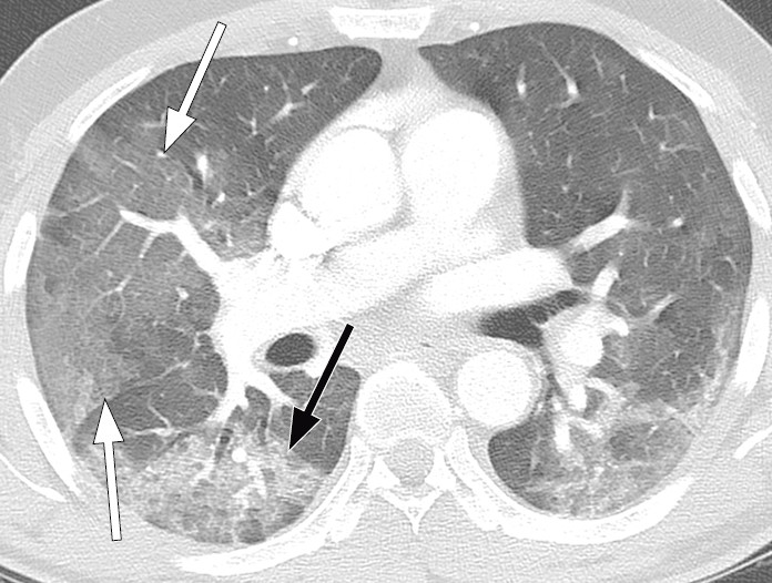 Figur 5 Pasient med covid-19. CT thorax syv dager etter symptomdebut viser utbredte bilaterale mattglassfortetninger (hvite&hellip;
