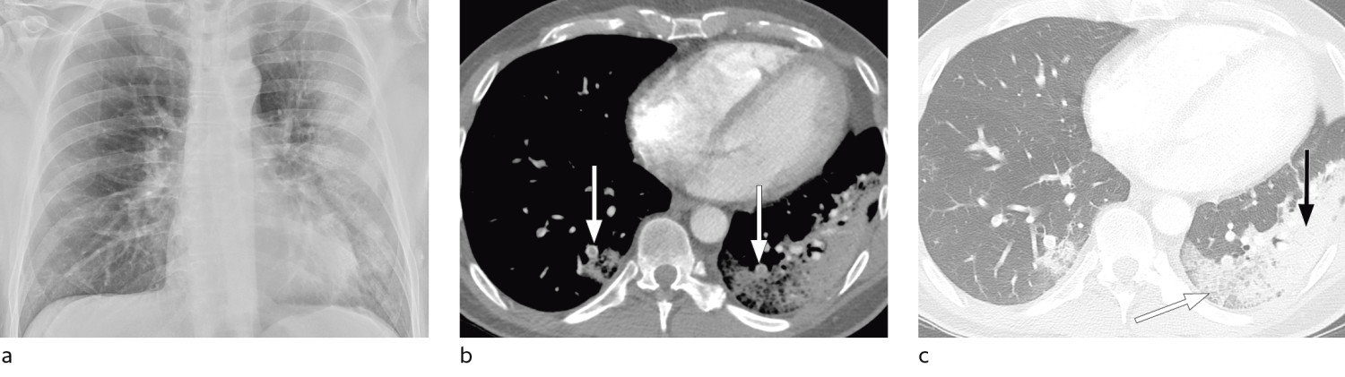 Figure 7 a) Patient with COVID-19 hospitalised because of reduced general condition. Bedside chest X-ray 11 days after&hellip;